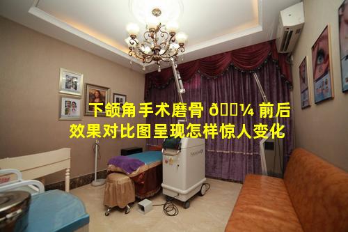 下颌角手术磨骨 🐼 前后效果对比图呈现怎样惊人变化